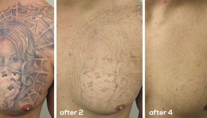 laser tattoo removal process