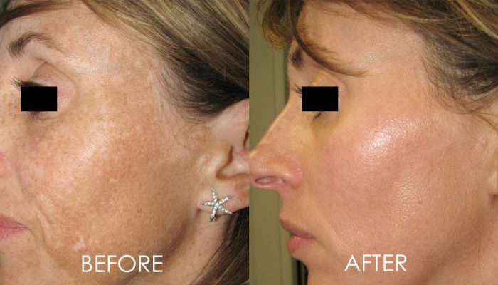 before and after laser facial