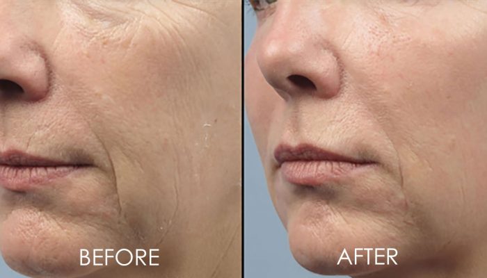 before and after of skin tightening